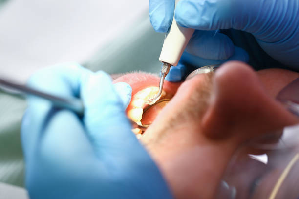Best Emergency Dentist for Lost Fillings or Crowns in Gladwin, MI